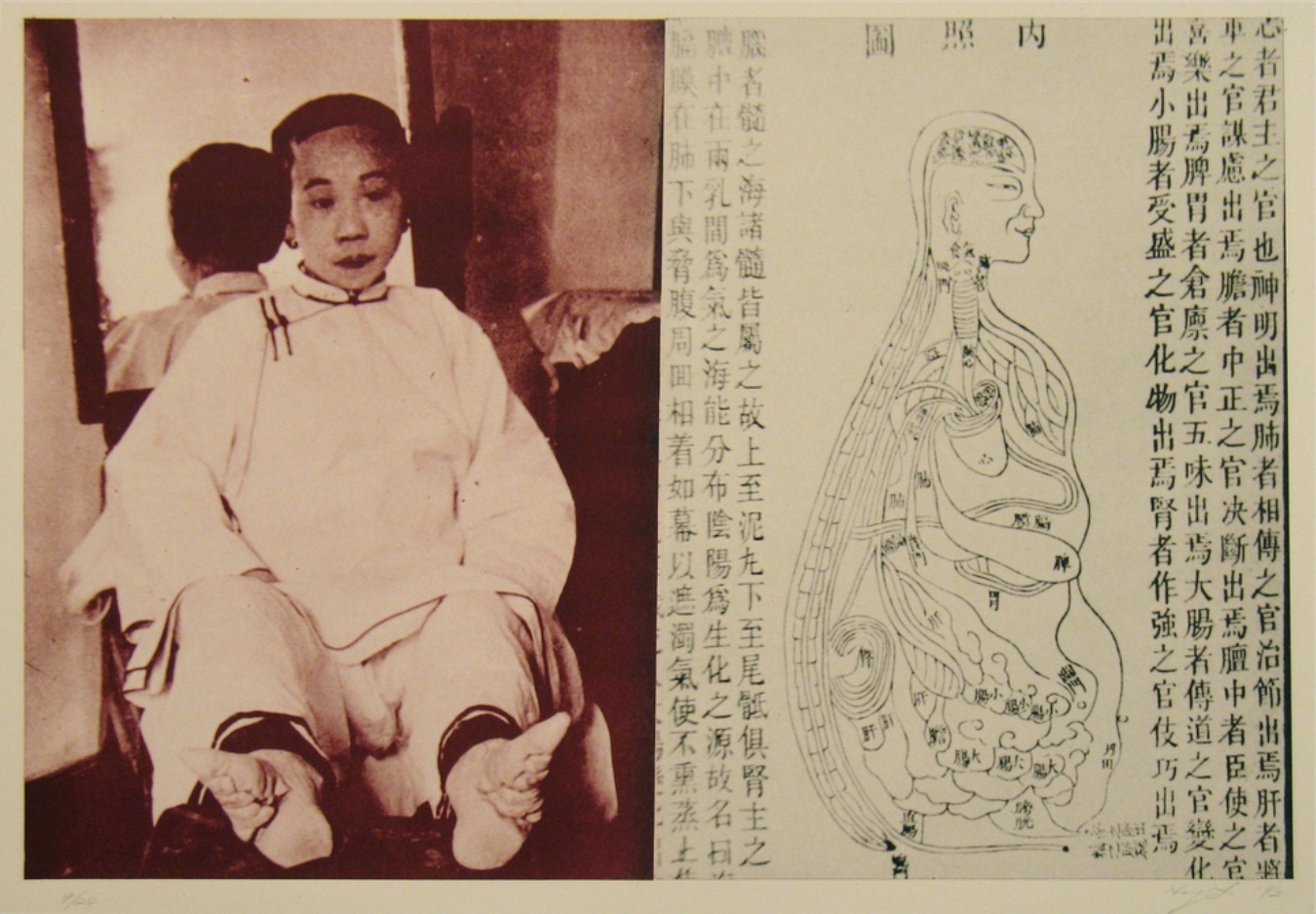 A sepia-toned photograph of an Asian person with deformed feet sits alongside a diagram of the human body flanked by texts in an Asian language