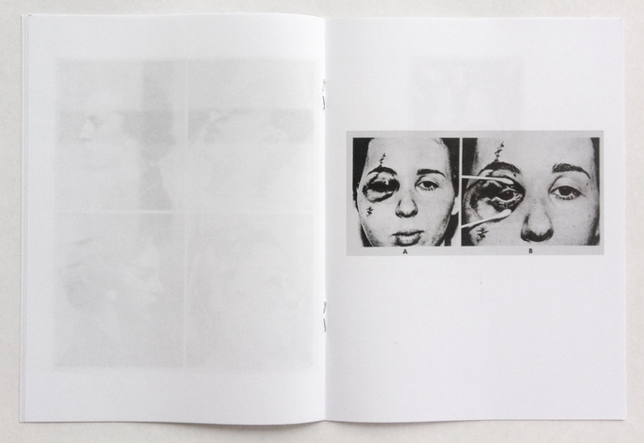 Facial Fractures thumbnail 2